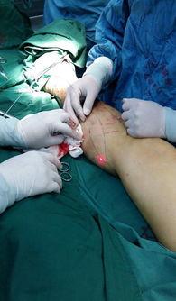 静脉曲张手术视频